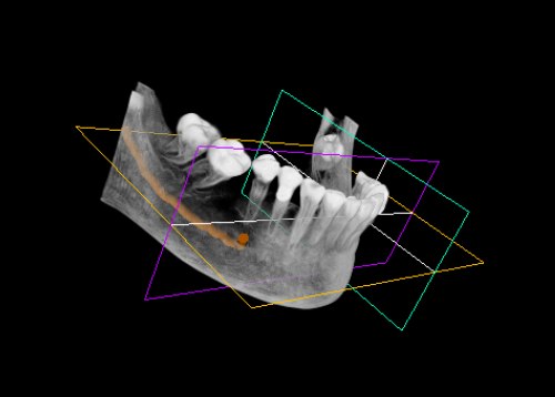 DVT gerendert mit Nervdarstellung