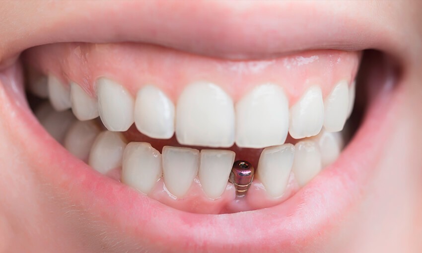 Befestigung von Zahnprothesen